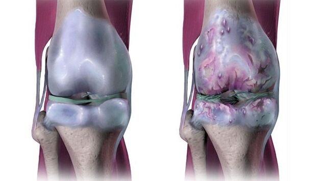 Zdravý kolenný kĺb a postihnutý artrózou