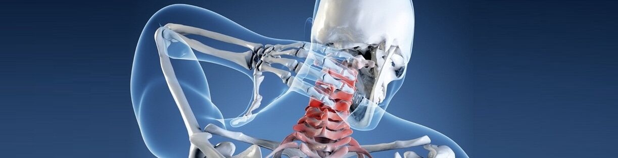 Osteochondróza ľudskej krčnej chrbtice