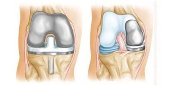 artroplastika na artrózu kolenného kĺbu