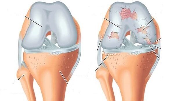 zdravý kĺb a artróza kolenného kĺbu