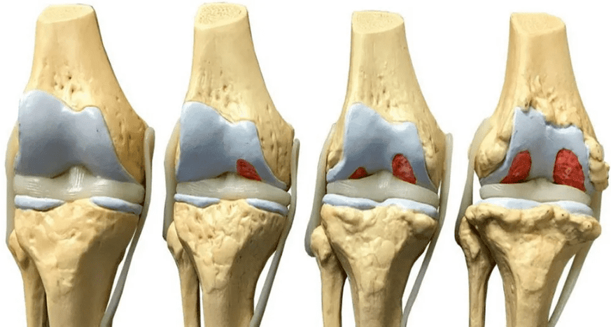 poškodenie kolenného kĺbu v rôznych štádiách vývoja artrózy