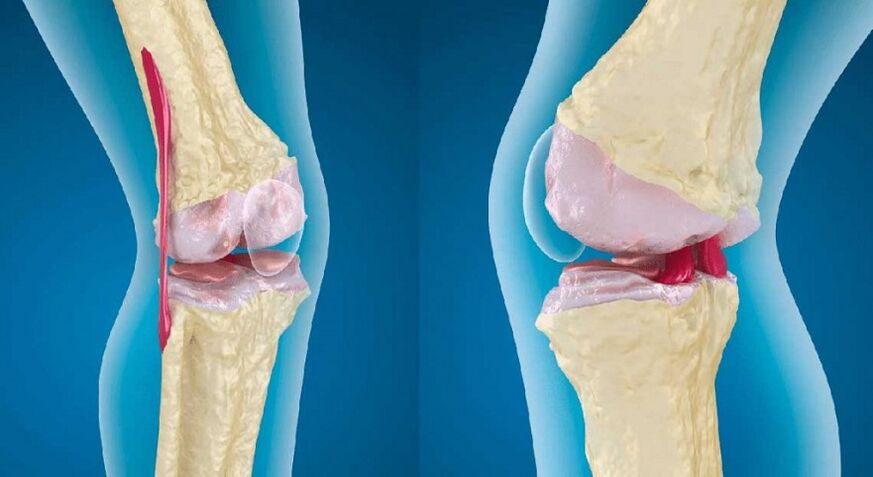 zdravý kĺb a artróza kolenného kĺbu