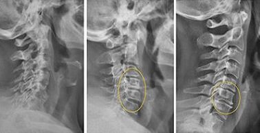 obrázky krčnej chrbtice na diagnostiku