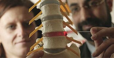 štúdium osteochondrózy na modeli chrbtice
