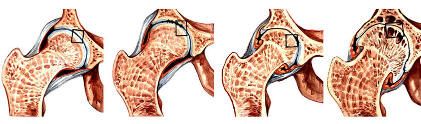 Stupeň vývoja artrózy bedrového kĺbu