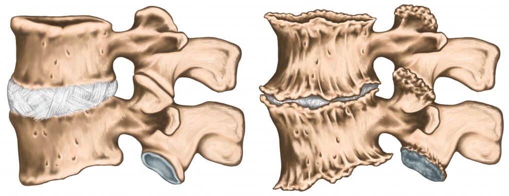 bolesť chrbta v dôsledku poranenia chrbtice