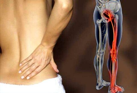 bolesť dolnej časti chrbta v dôsledku zápalu sedacieho nervu