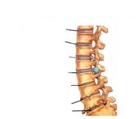 Príznaky osteochondrózy