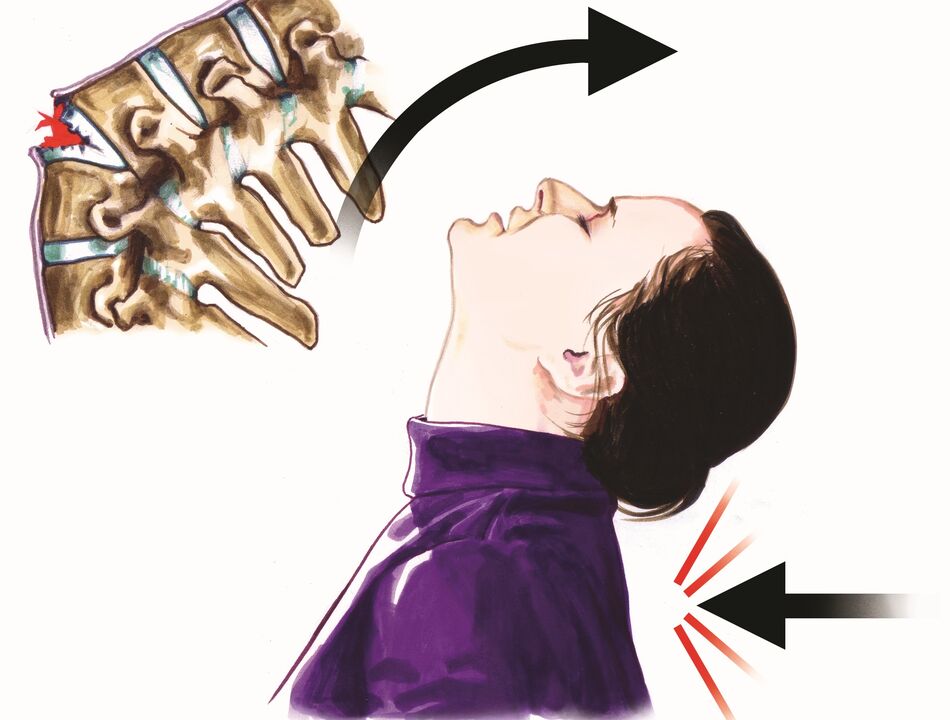 poškodenie chrbtice ako príčina bolesti krku