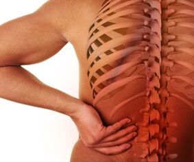 bolesť chrbta s bedrovou osteochondrózou