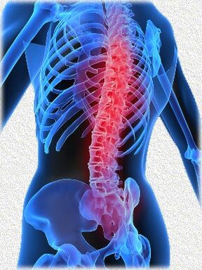 osteochondróza a metódy jej liečby